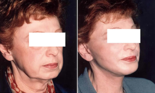 Neck Lift Before And After