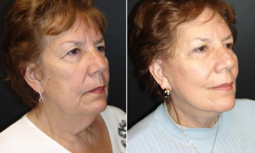 Before And After Neck Lift Surgery