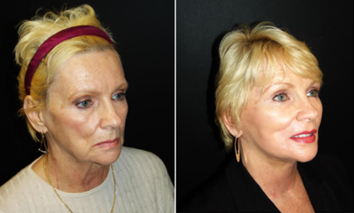 Neck Lift Results