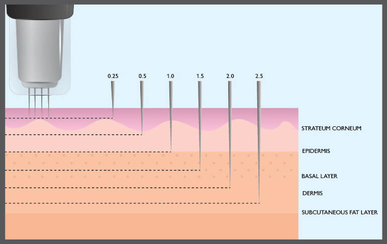 Microneedling Overview