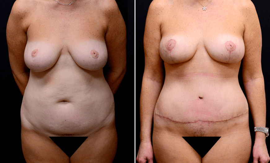 Before And After Tummy Tuck Surgery