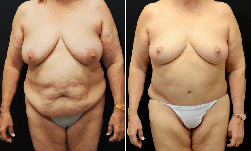 Tummy Tuck Before And After